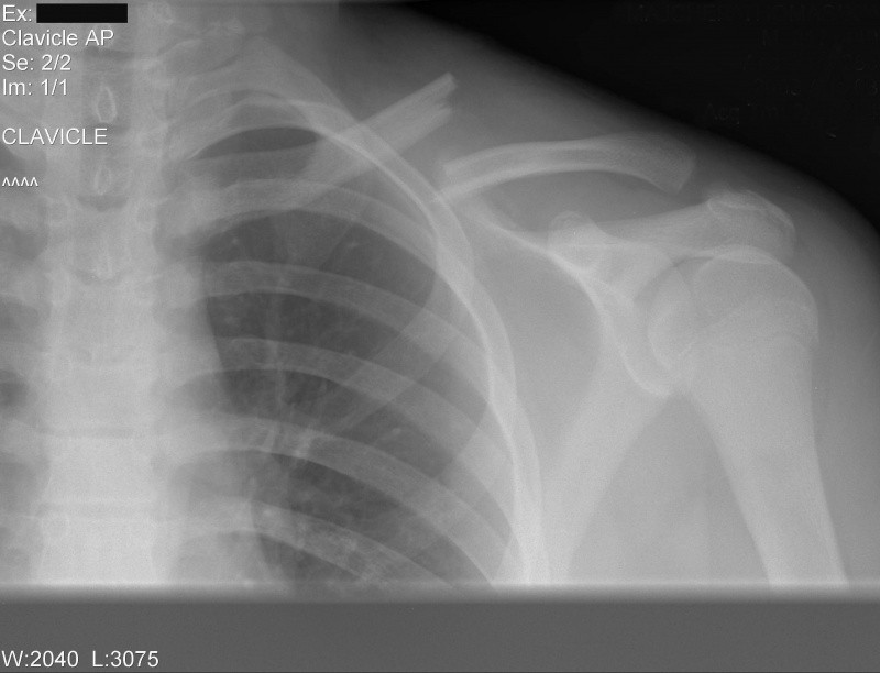 Clavicule fracture Fred 03-03-2010